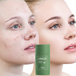 Charger l'image dans la galerie, Masque de thé vert contre les boutons du visage pour HOMMES et FEMMES