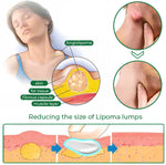 Charger l'image dans la galerie, 2 Boîtes de Crème pour Guérir des Lipomes en 30 jours