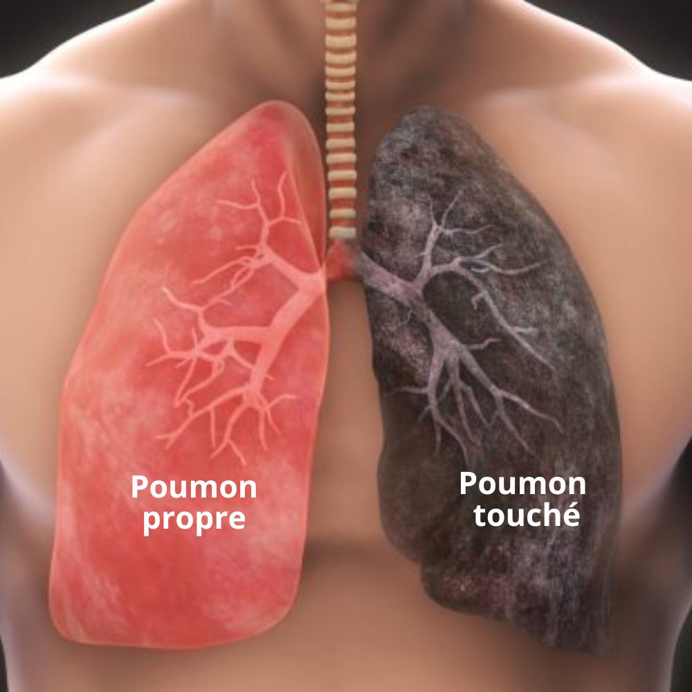 Spray Nasal pour le Nettoyage des Poumons