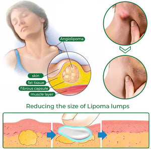 2 Boîtes de Crème pour Guérir des Lipomes en 30 jours